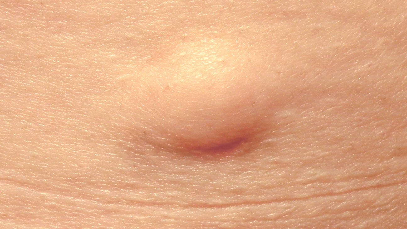 Swollen left anus under skin