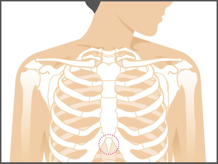 xiphoid-prozess-schmerzen-klumpen-entfernung-und-mehr