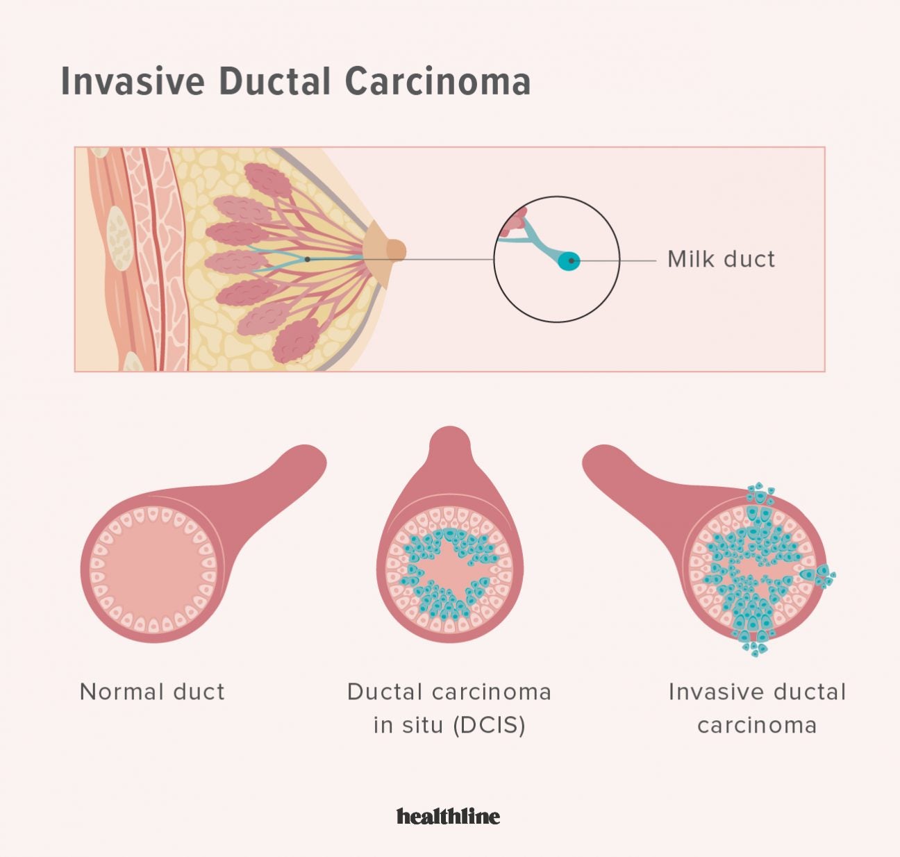 Invasive Breast Cancer Types Symptoms Treatment Outlook