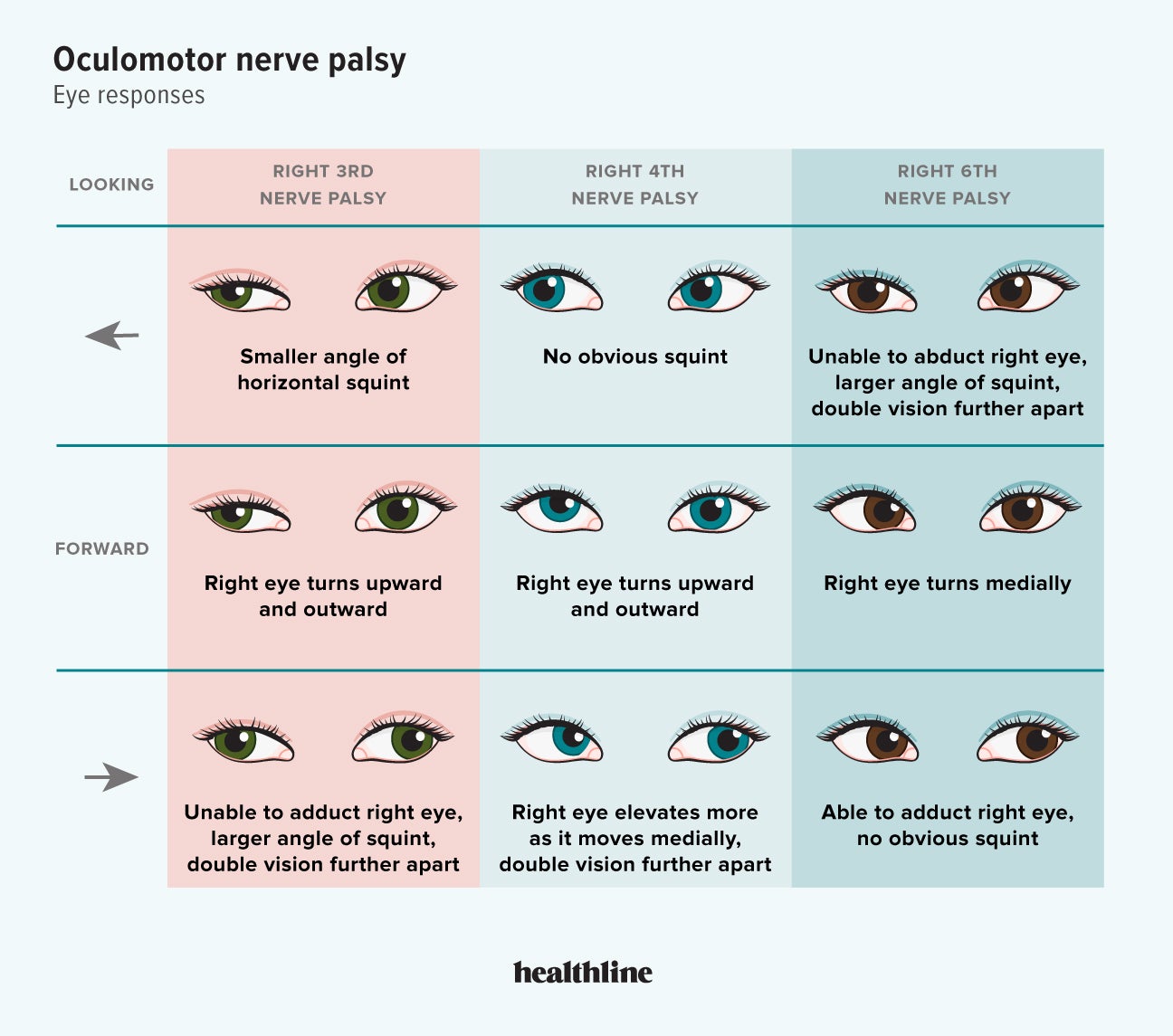 Your Guide To Oculomotor Nerve Palsy And Its Treatment