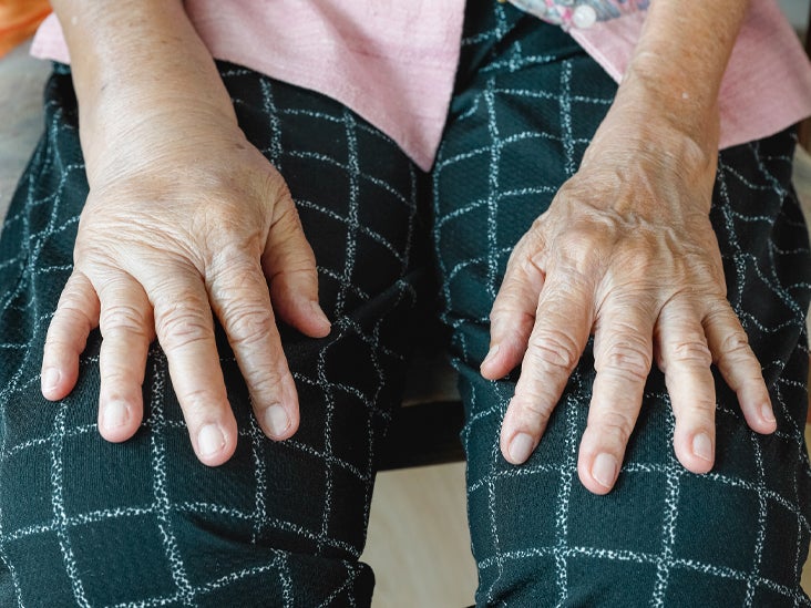 Inflammatory Rheumatism: Symptoms, Types, and More