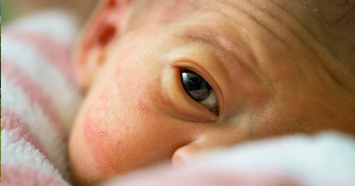 skin-problems-in-the-premature-baby-healthline