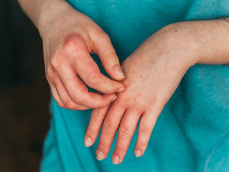 atopic dermatitis on fingers