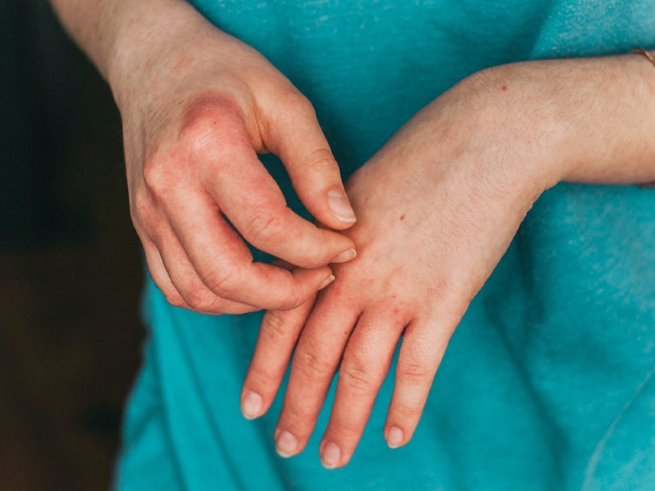 dermatitis on top of hands