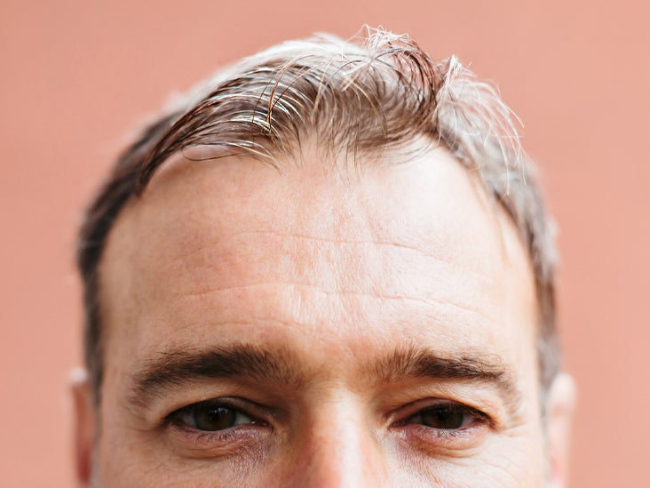 Balding Causes, Signs, Treatment, and Prevention for Men and Women