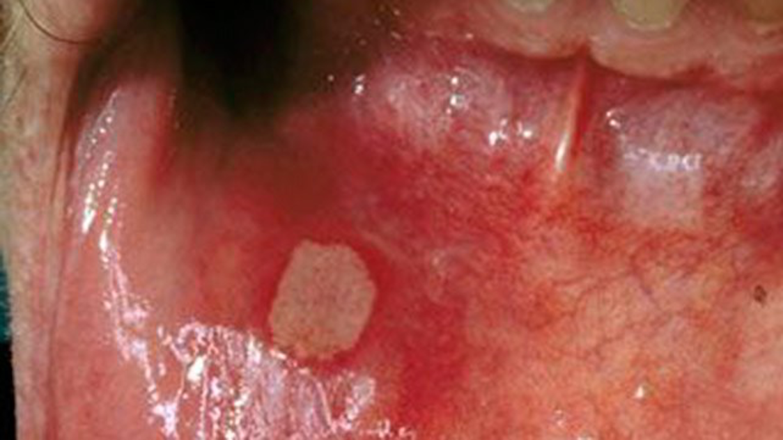 hiv symptoms mouth