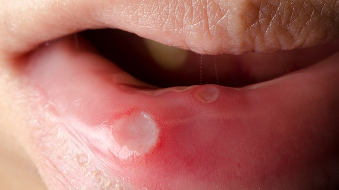 hiv symptoms mouth