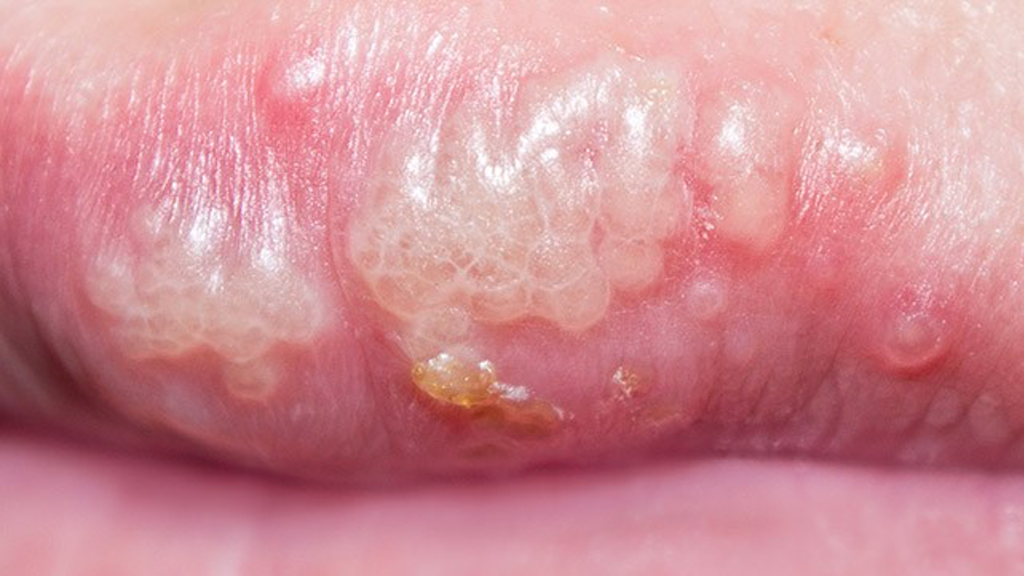 hiv bumps under tongue