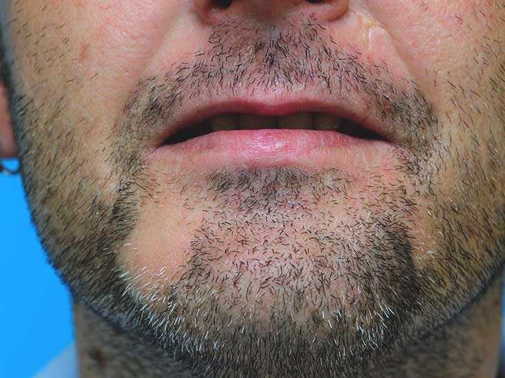 Beard bald spots rogaine for Does Rogaine