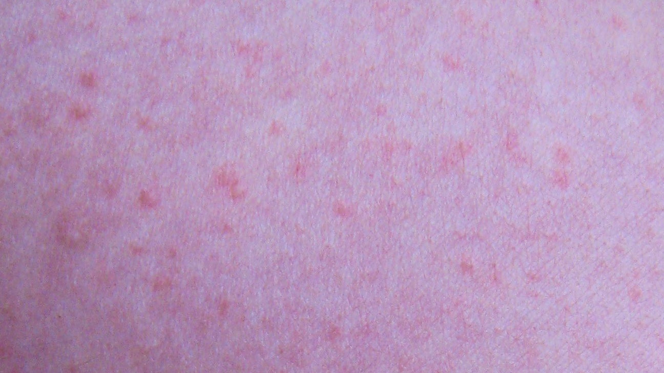 Heat Rash In Toddlers And What To Do