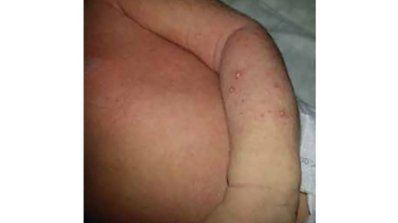 Heat Rash In Toddlers And What To Do