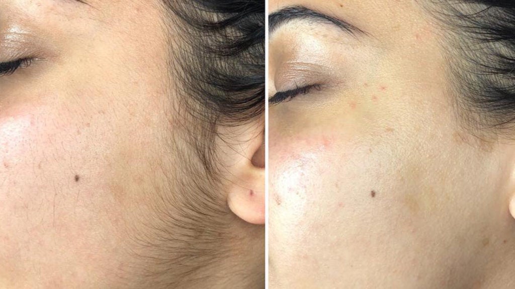 Dermaplaning Before And After 1296x728 Body 1 1024x575 