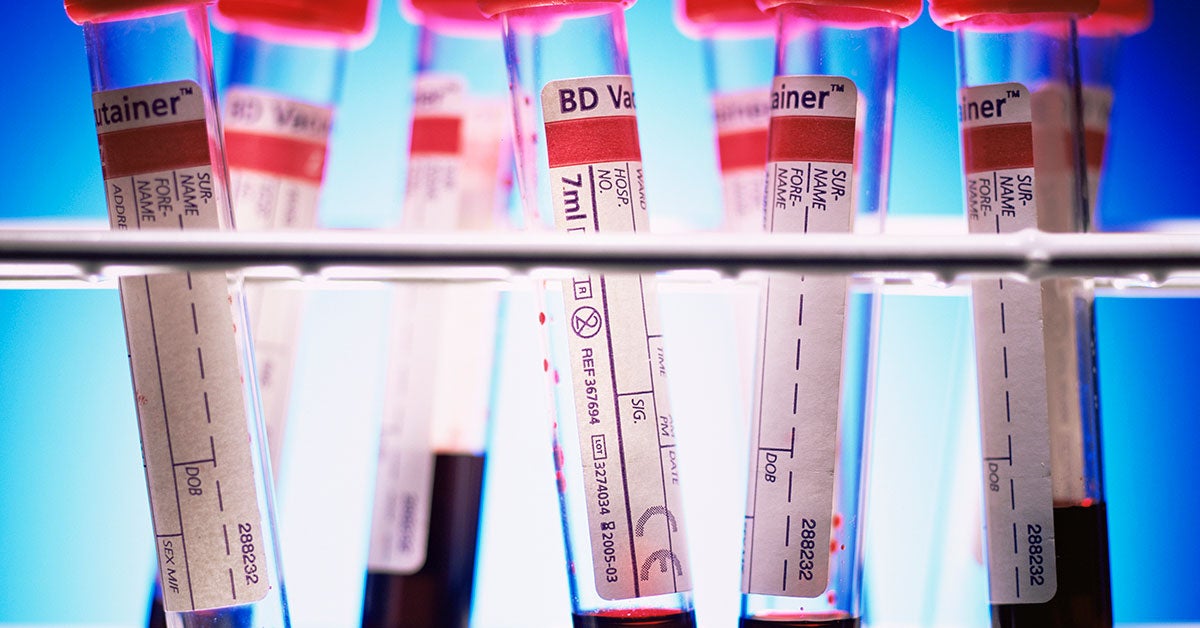 Diabetes Risk From Vitamin D Deficiency, Gum Disease