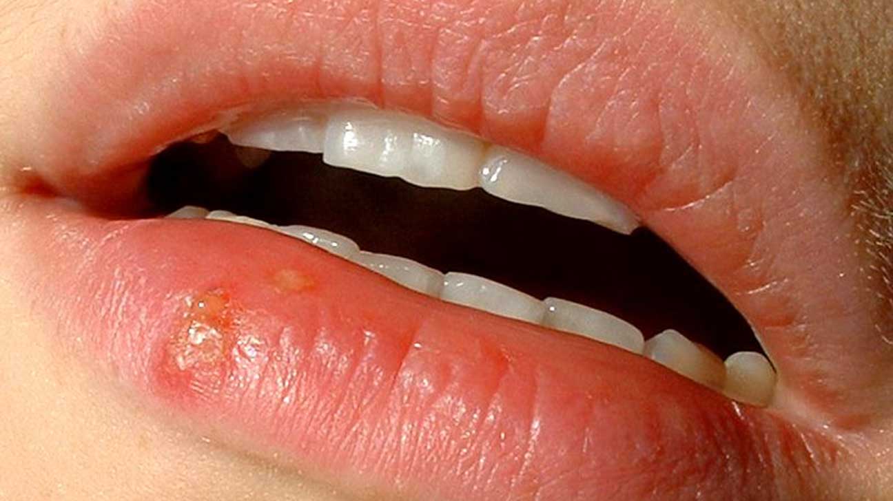 soft palate canker sore