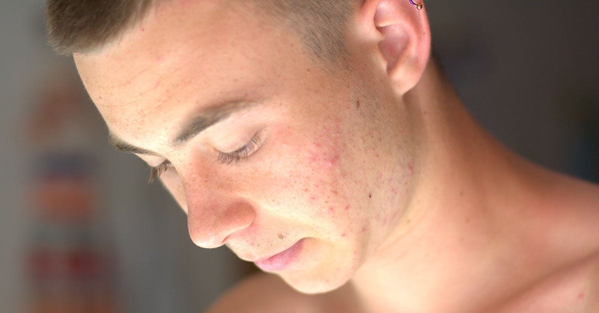 Retin-A for Acne: Uses, Side Effects, and More