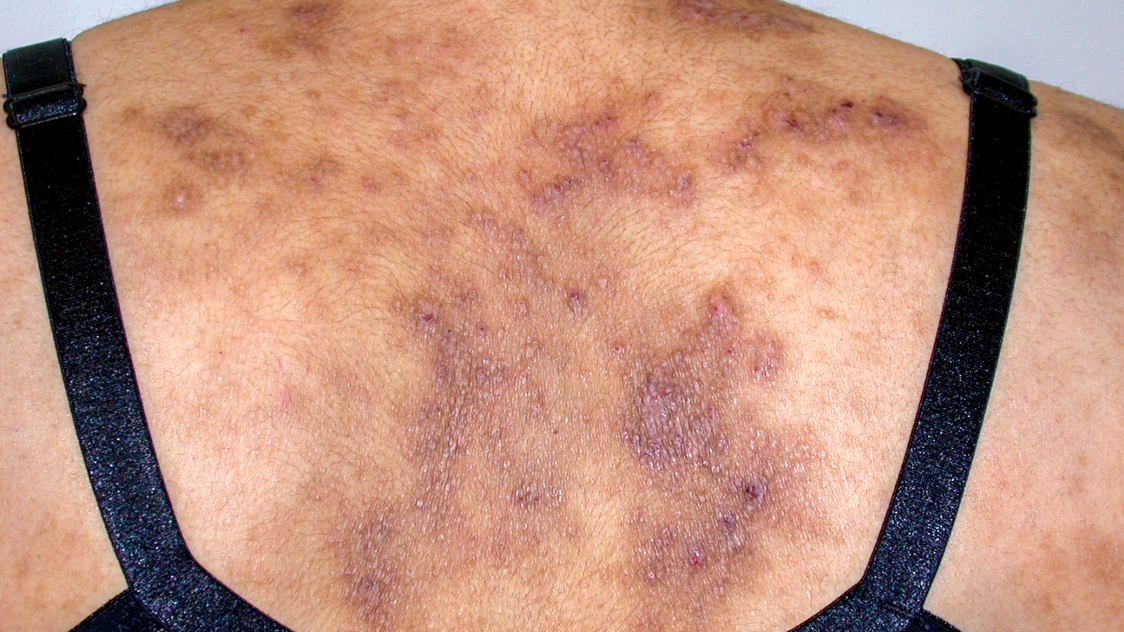 Rashes And Skin Conditions Associated With Hiv And Aids