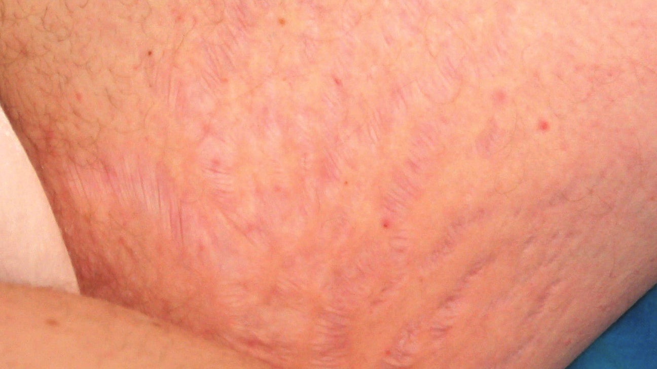 Vejhus trappe Bliver til Stretch Marks on Breasts: Causes, Treatment, Prevention, and More