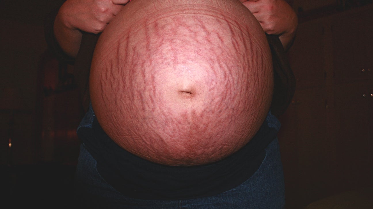 Are Stretch Marks Genetic?, Your No.1 Question Answered