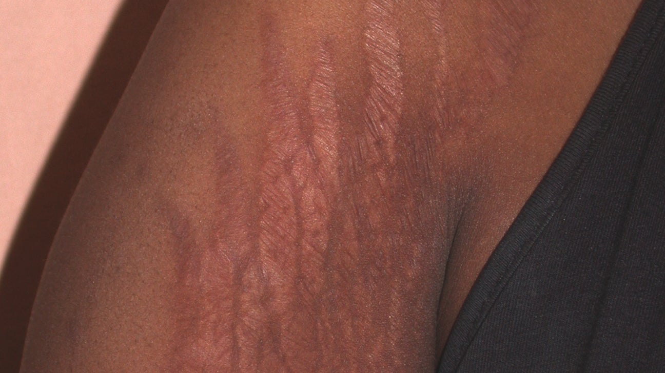 Stretch Marks on Breasts: Causes, Treatment, Prevention, and More