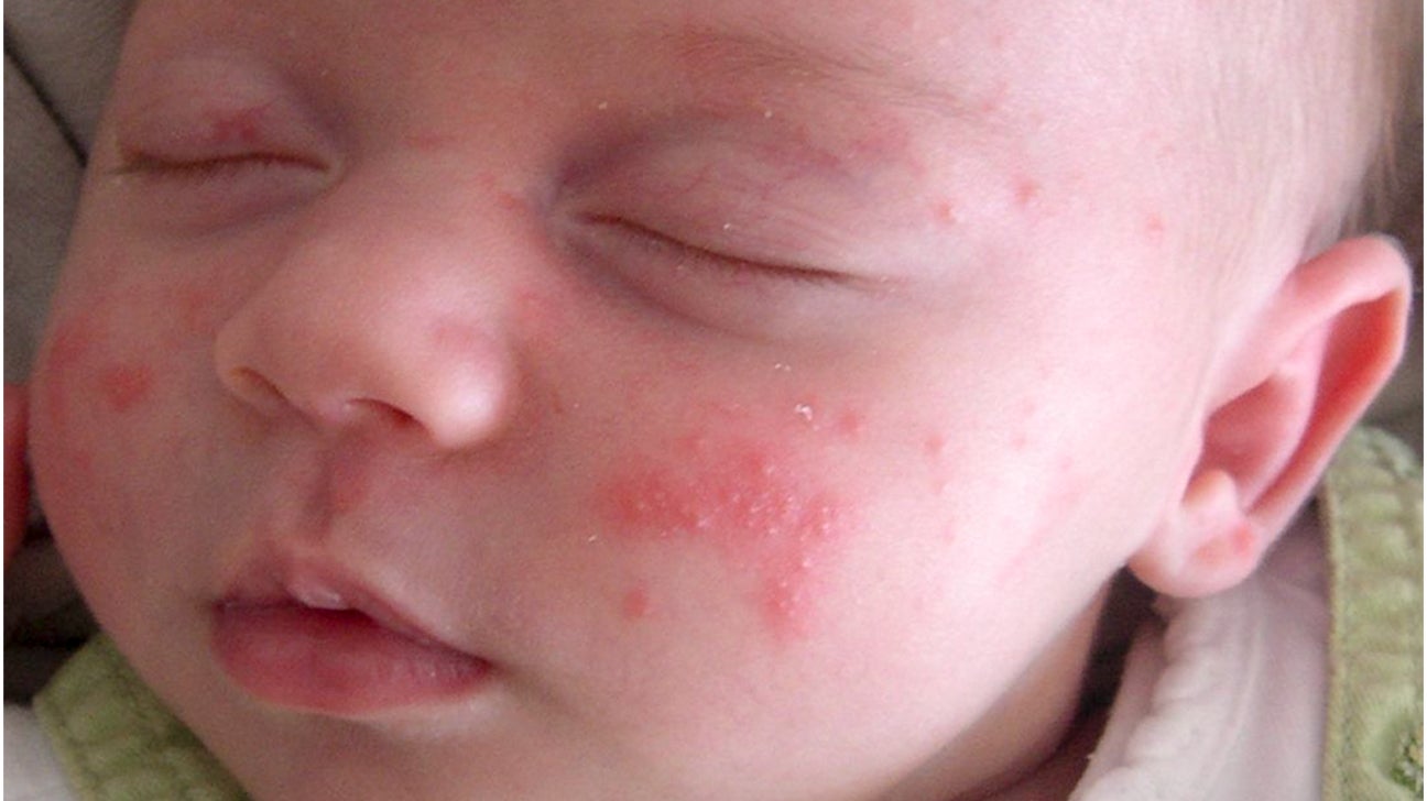 Allergic skin rash baby