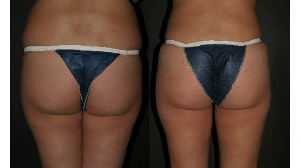 Non-Surgical Sculptra Butt Lift (BBL)  South Florida Center for Cosmetic  Surgery