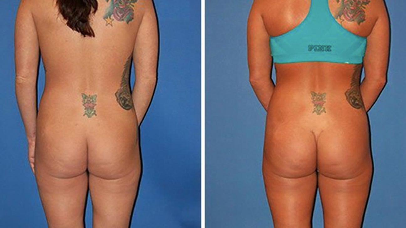 Woman getting therapy for post-traumatic stress after bum implants