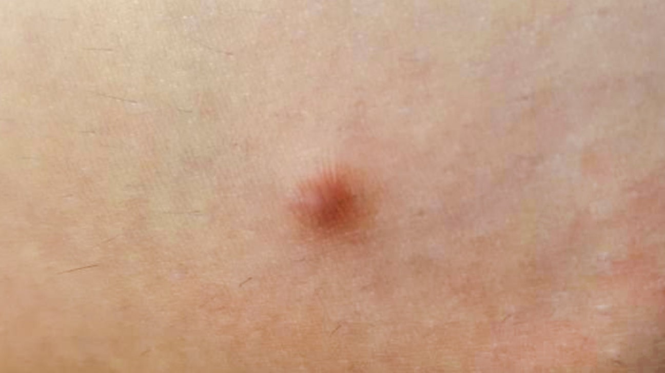 Painful Lump Under Skin Gaswnfc