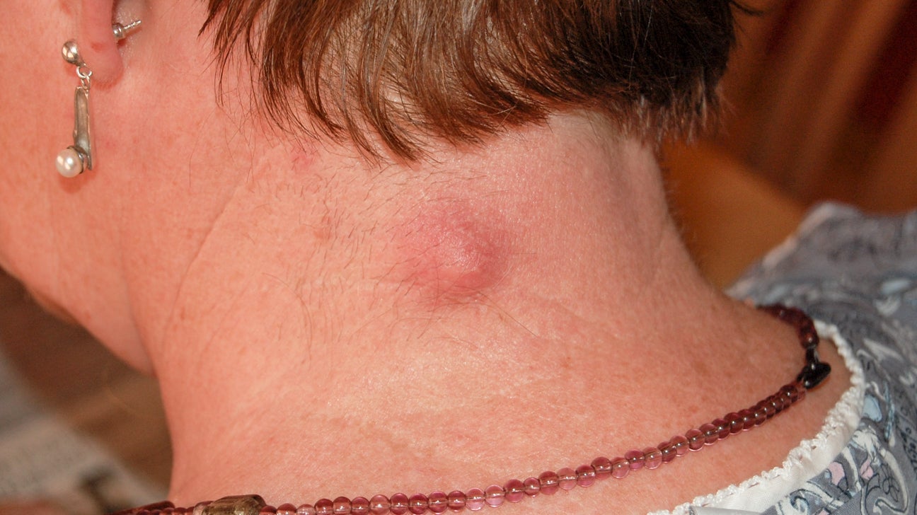 hard lump under skin: 8 causes and how they're treated