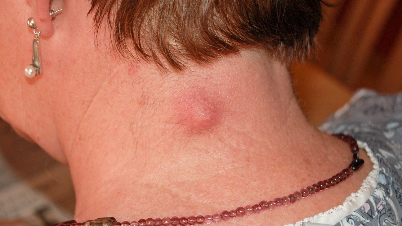 Hard Lump Under Skin 8 Causes And How They Re Treated