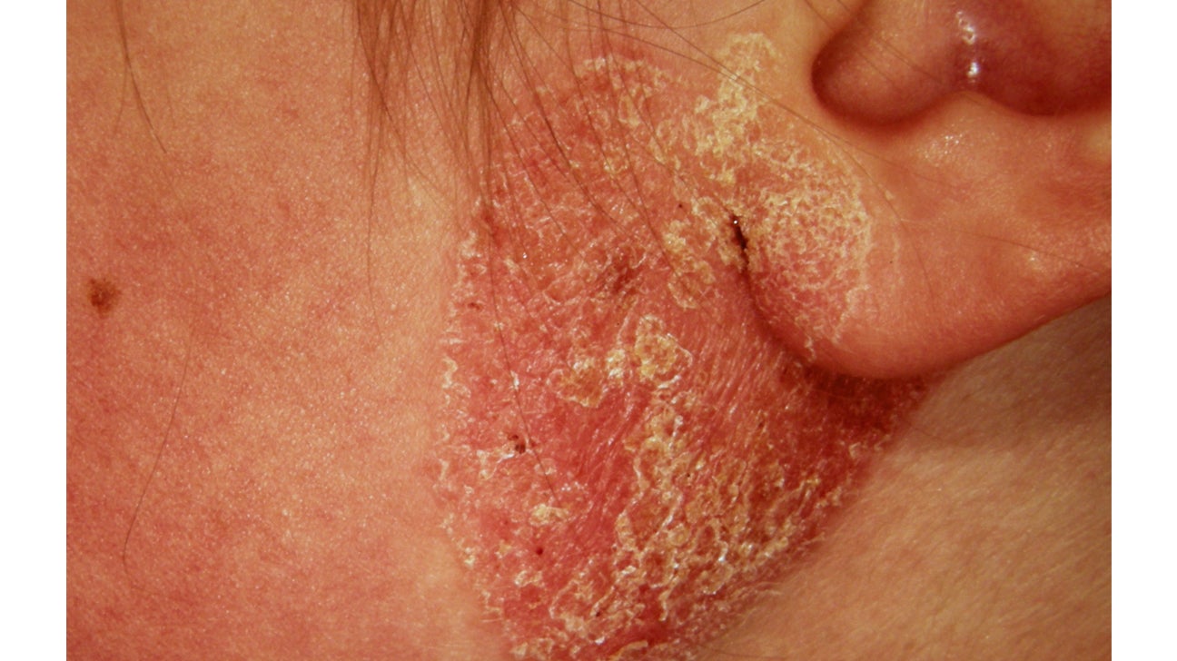 crusty eczema behind ears