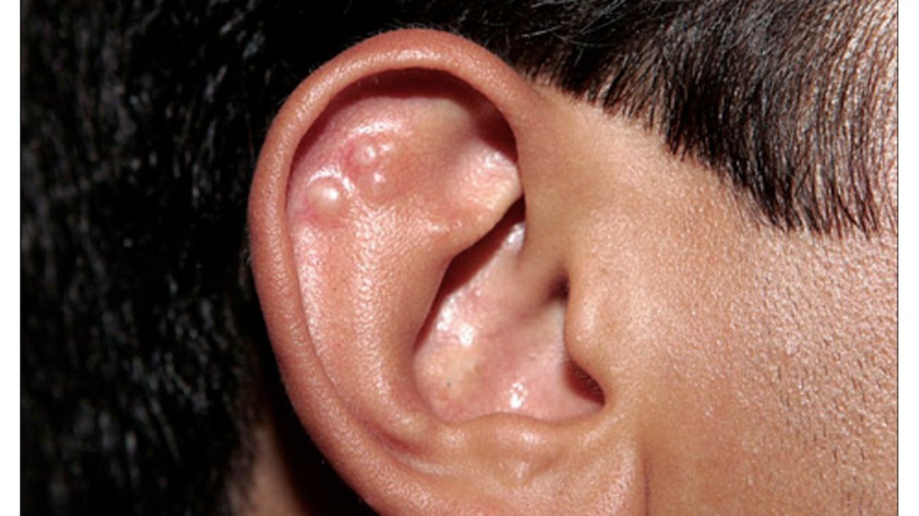 rubella rash behind ears