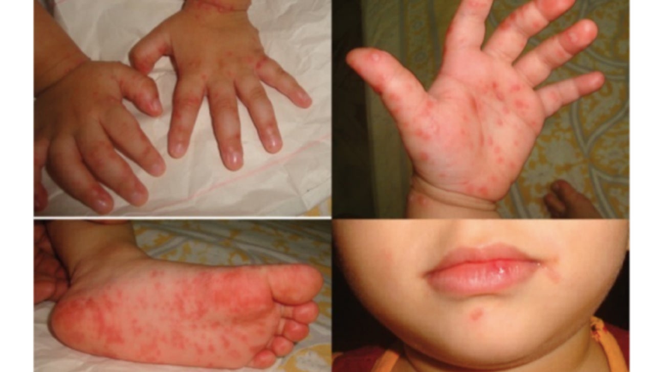 baby rash around mouth and legs