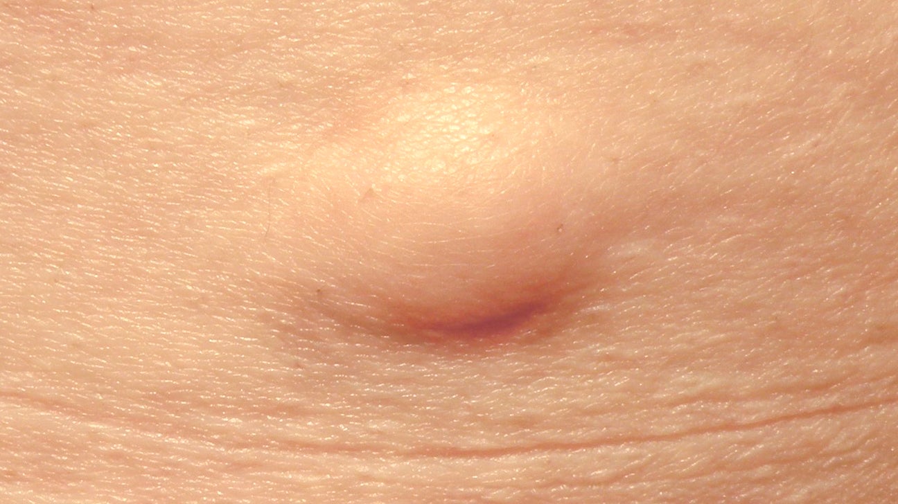 Hard Lump Under Skin 8 Causes and How They re Treated