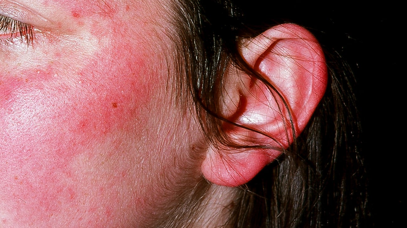 Rash Behind Ear: Causes, Symptoms, and Treatments