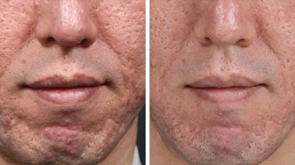 How Does Microneedling Help Acne Scars?  