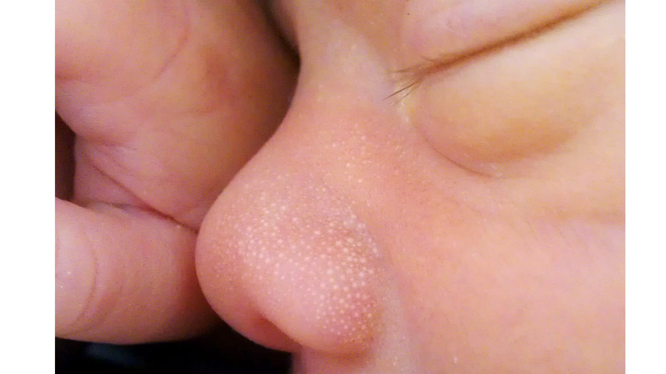 Baby Rash Causes Types Treatments Prevention