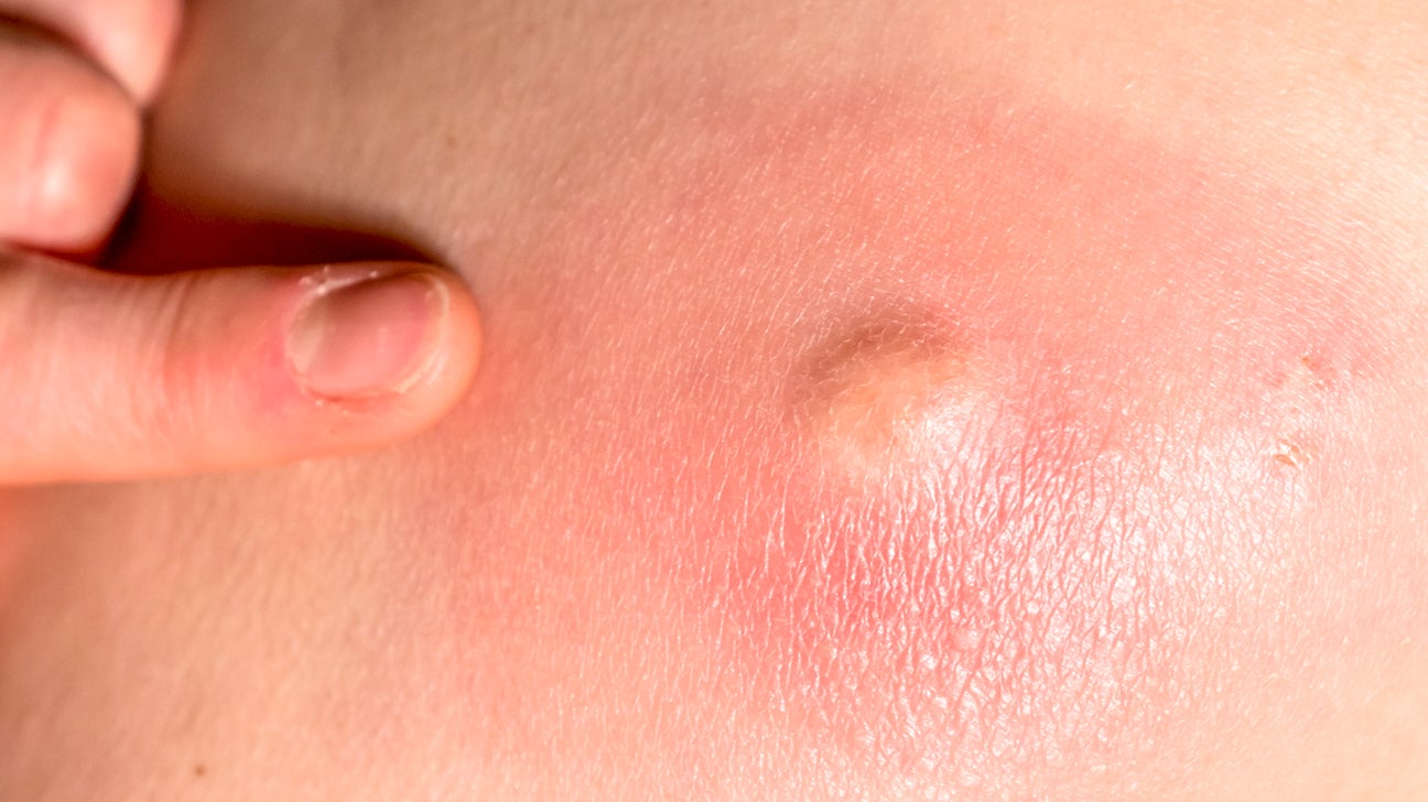 Hard Lump Under Skin: 8 Causes and How They're Treated.