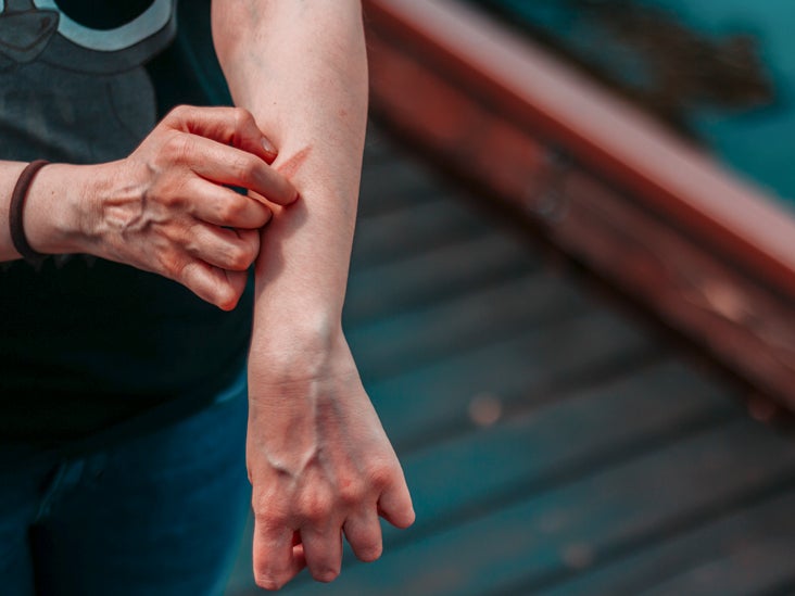 Chronic Idiopathic Urticaria And Diet Foods To Eat Avoid And More