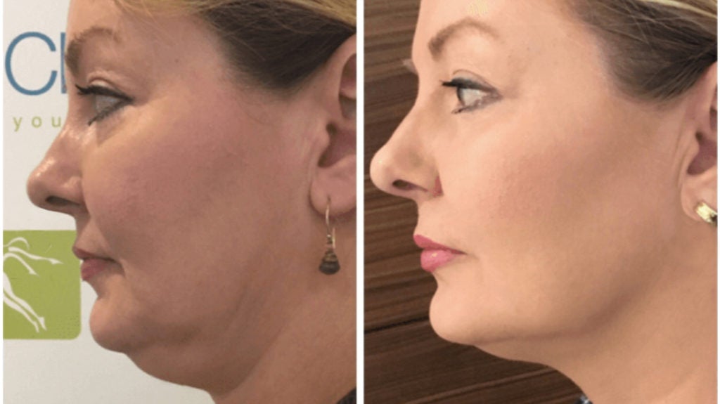 Half face lift! The power of Contour and Highlight! 