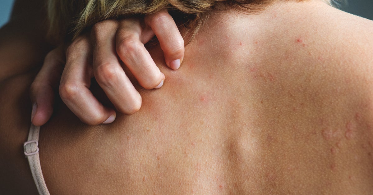 rash that moves to different parts of the body