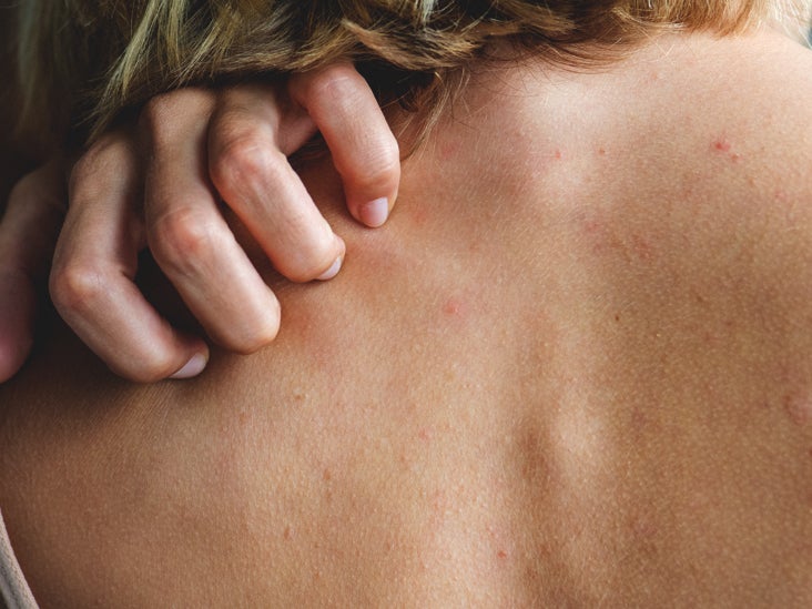 How to treat antibiotic allergic reaction rash