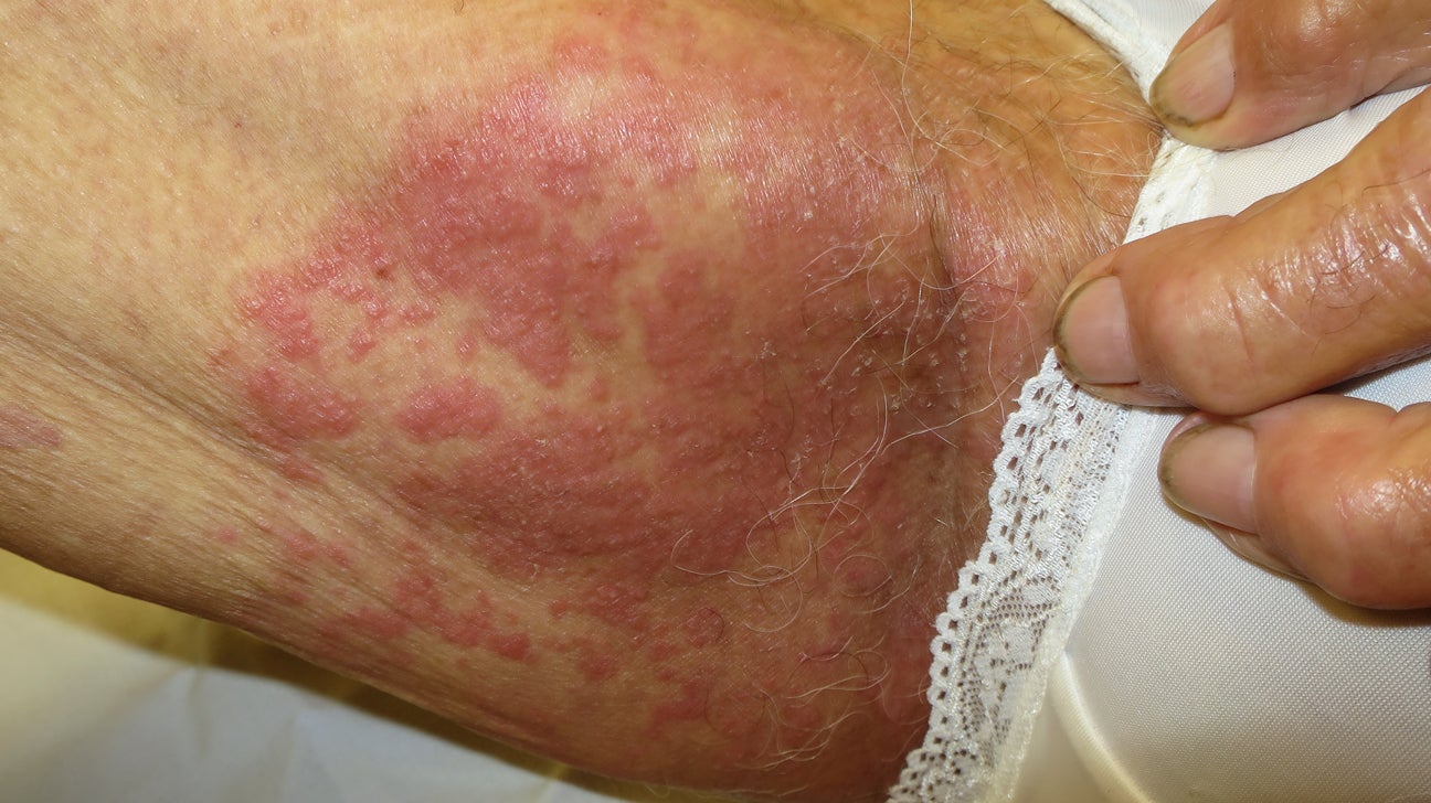 Heat rash - treatments, symptoms and causes