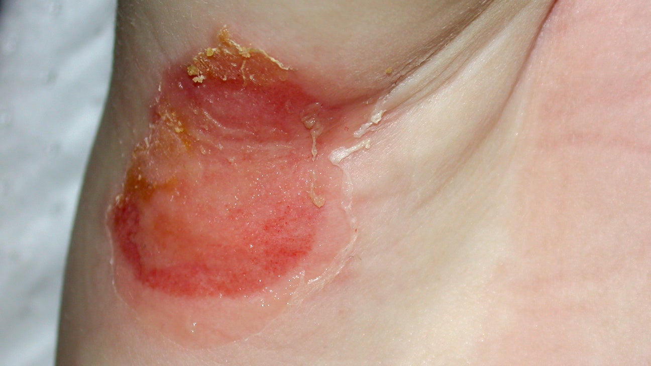 Awful heat rash in stomach fold now weeping - warning - photo attached