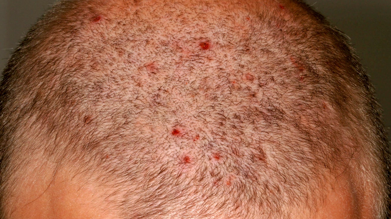 Scalp Folliculitis Treatment Shampoo