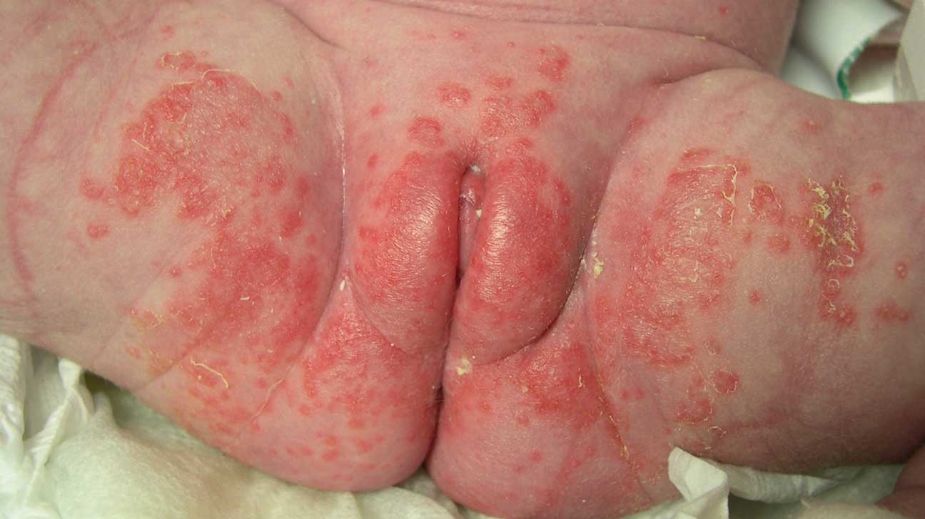 fungal yeast infection