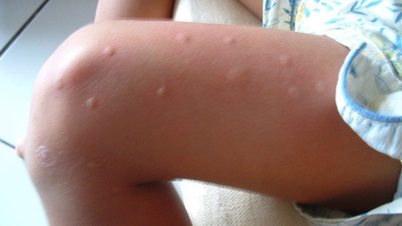 bed bug bites on black babies