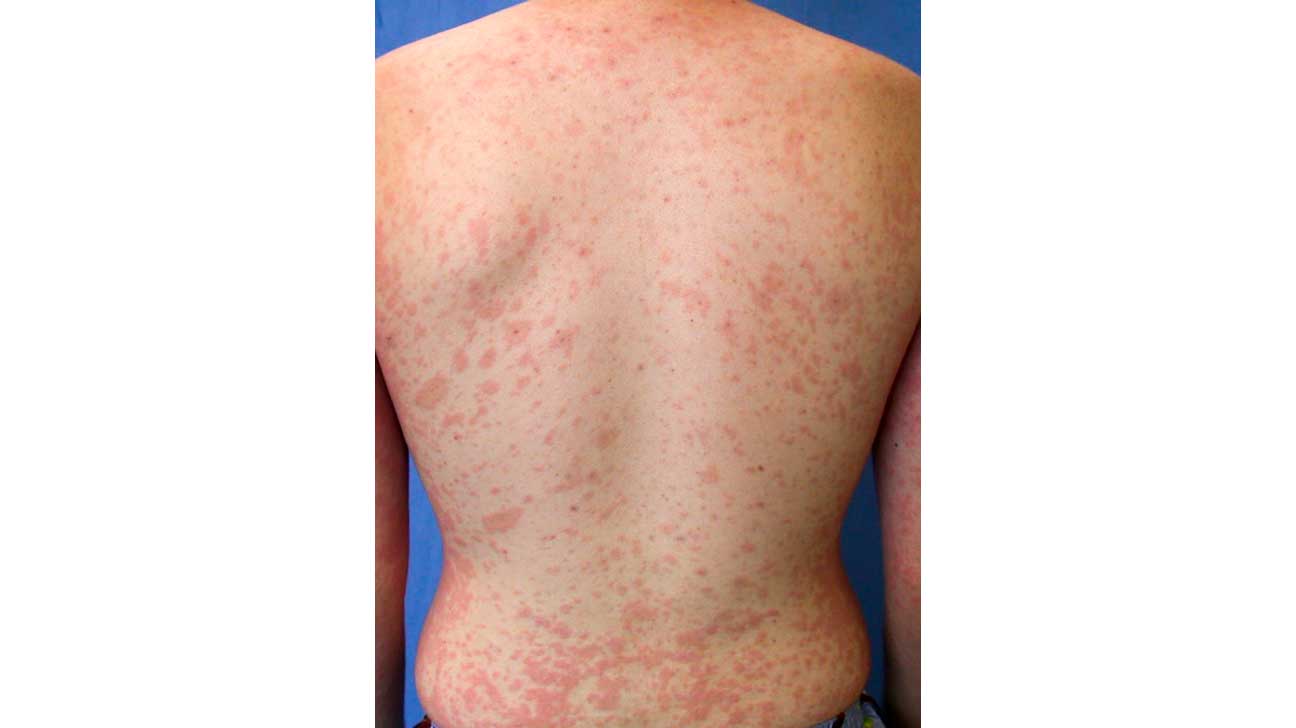 Modstand Besættelse slette Red Spots on Skin: Causes, Treatments, and More