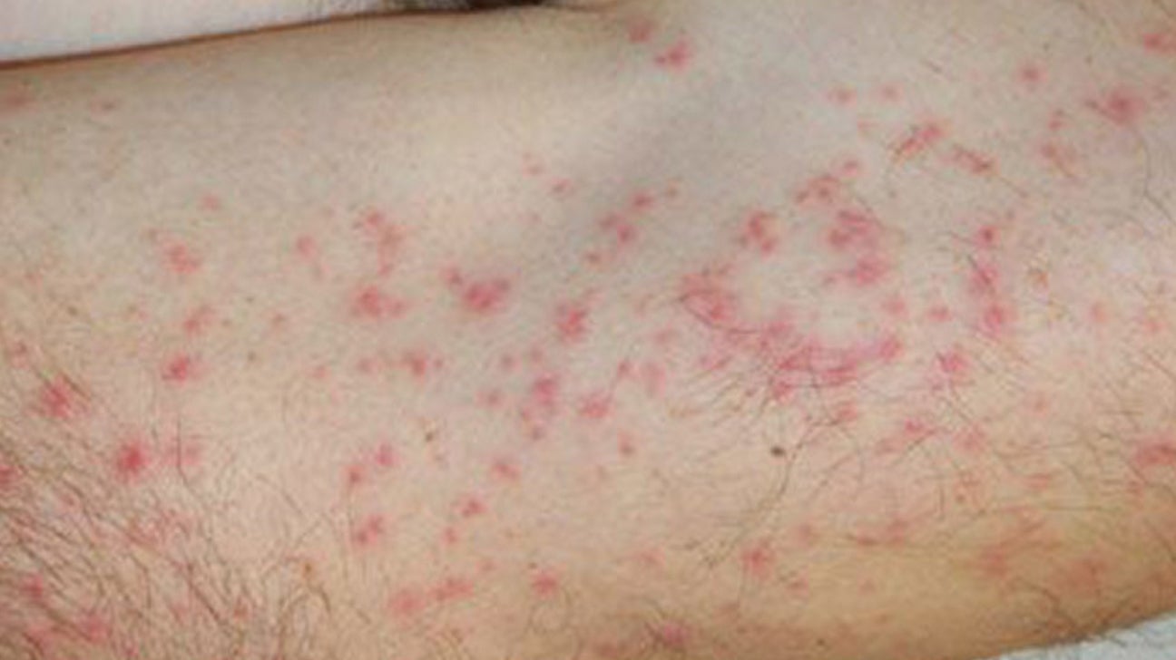 coq-menstruation-en-cons-quence-small-red-spots-on-skin-marque