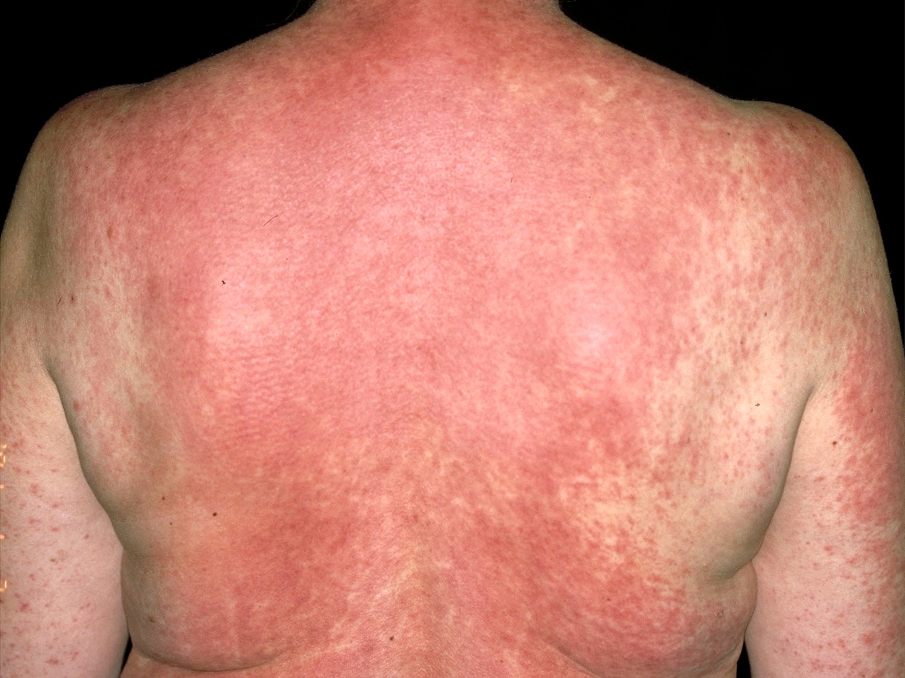 Drug Rash And Eruption Symptoms Pictures Causes And Treatment