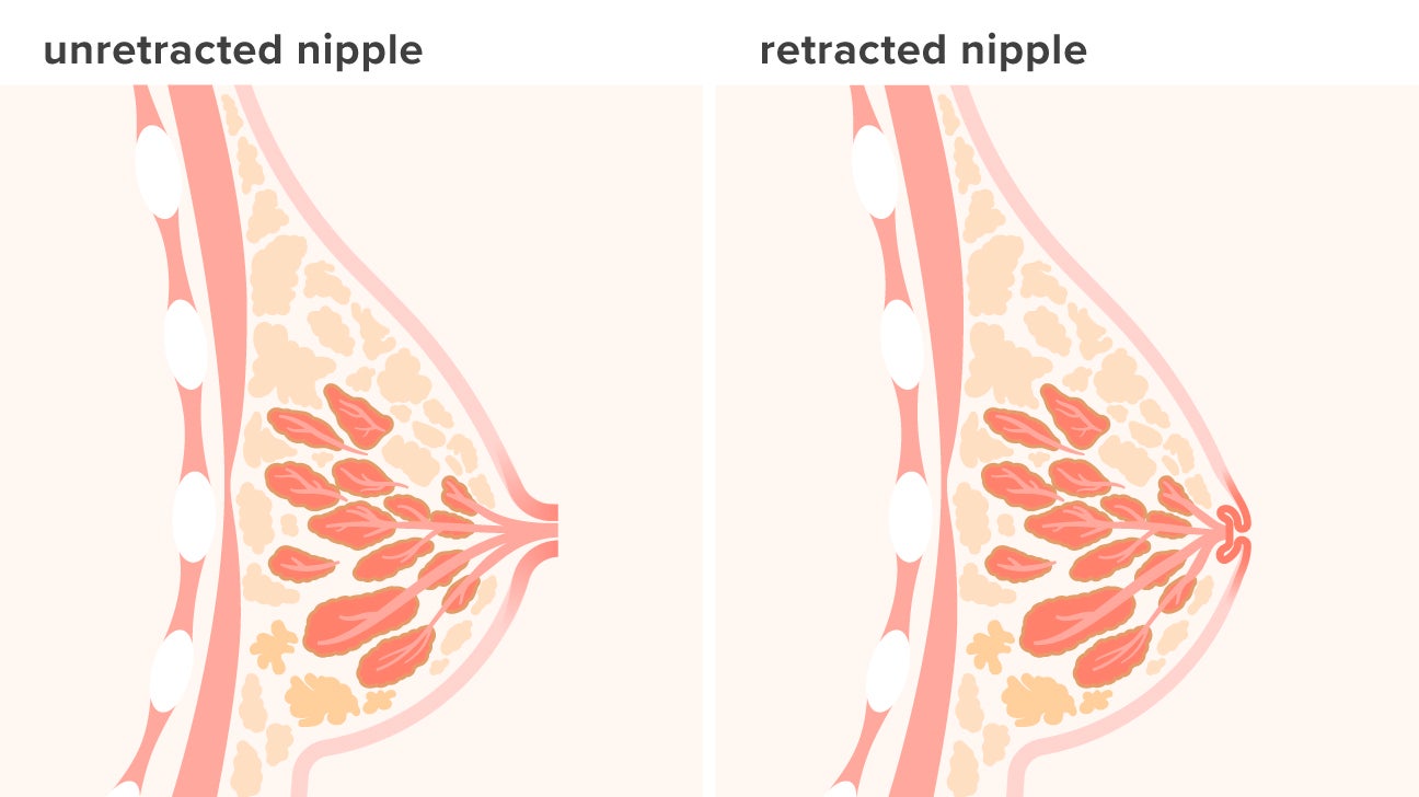Nipple Retraction: Causes, Treatment, Picture, and More